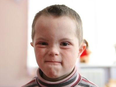 Ребенок с синдромом Дауна. Фото: sunchildren.narod.ru